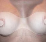 Увеличение груди - После