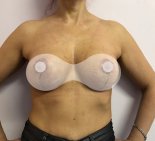 Подтяжка груди с увеличением - После