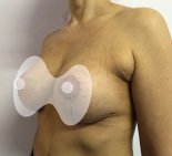 Подтяжка груди с увеличением - После