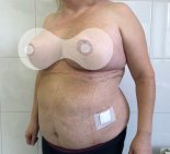 Уменьшение груди с вертикальной подтяжкой и липосакция живота - После