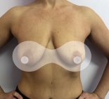 Подтяжка груди с увеличением - До