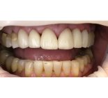 Реставрация зубов с использованием виниров - После