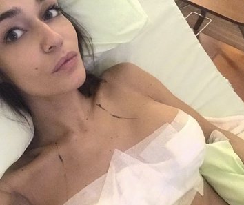 Уменьшение груди для Алены Водонаевой - После