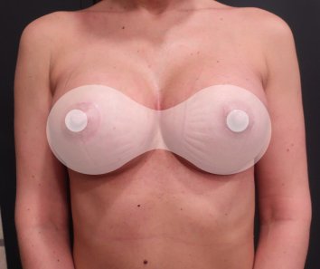 Увеличение груди без подтяжки - После