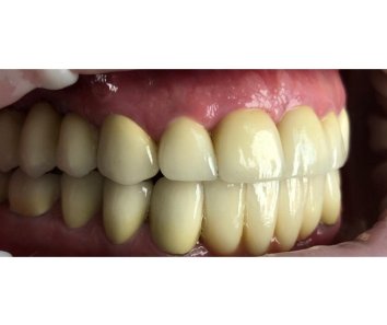 Реставрация зубов с использованием виниров - После