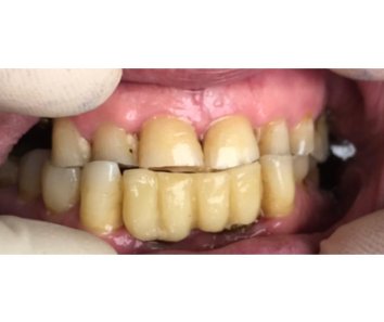 Реставрация зубов с использованием виниров - До