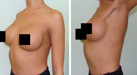 Эндоскопическая пластика груди: за и против