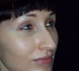 Ринопластика закрытым способом - До