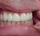 Эстетическая реставрация зубов - После