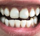 Отбеливание зубов - После