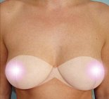 Уменьшение груди - После