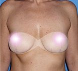 Уменьшение груди - После