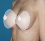 Увеличение груди - После