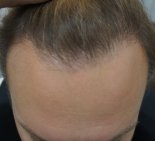Пересадка волос - После
