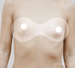 Увеличение груди - До