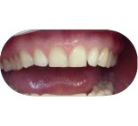 Реставрация зубов с использованием виниров - До