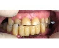 Реставрация зубов с использованием виниров