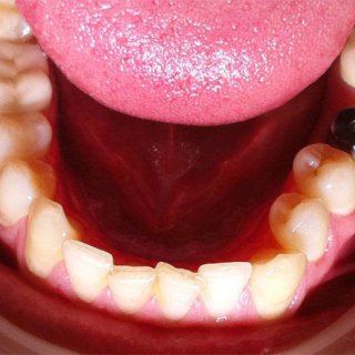 Протезирование зубов, фото до