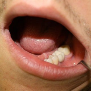 Протезирование зубов, фото после 