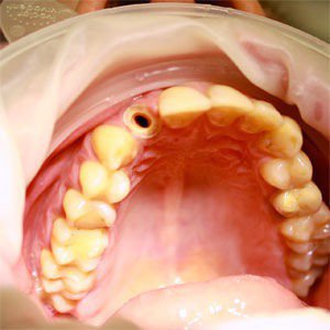 Протезирование переднего зуба, фото до