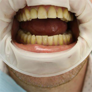 Протезирование переднего зуба, фото после