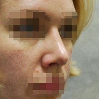 Выравнивание спинки носа, фото после