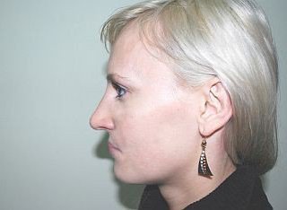 Исправление длинного, искривленного носа, фото после