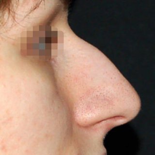 Устранение горбинки и понижение спинки носа. Фото до.