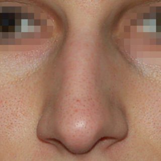 Устранение горбинки и понижение спинки носа. Фото до. Фас