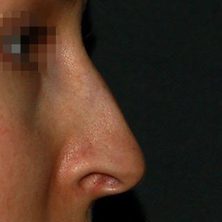 Коррекция спинки носа, полная риносептопластика. Фото до.