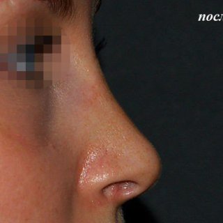 Коррекция спинки носа, полная риносептопластика. Фото после.