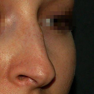 Коррекция спинки носа, полная риносептопластика. Фото после