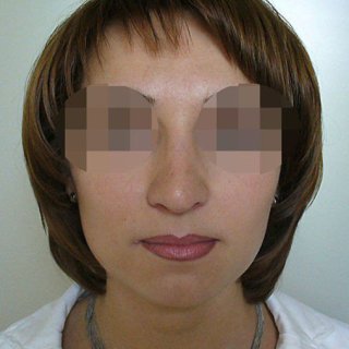 После ринопластики, анфас