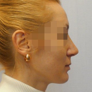 После ринопластики, фото профиль слева
