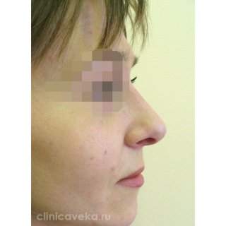 Фото профиль слева после ринопластики