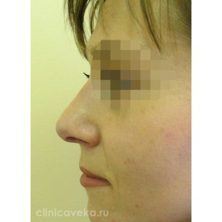 Фото профиль справа после ринопластики