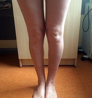 Пластика ног (фото до)