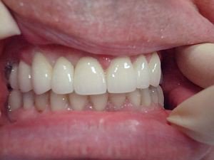 Эстетическая реставрация зубов, фото после