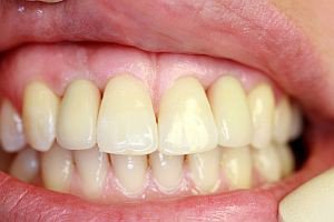Импланты зубов, фото после