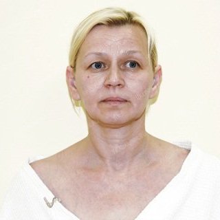 Людмила Бойло, фото до операции