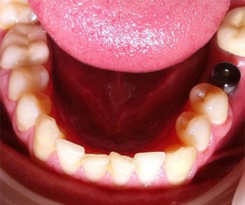 Протезирование зуба на импланте - До