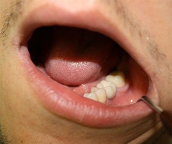 Протезирование зуба на импланте - После