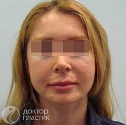 Имплантация нитей - До
