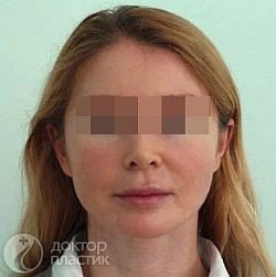 Имплантация нитей - После