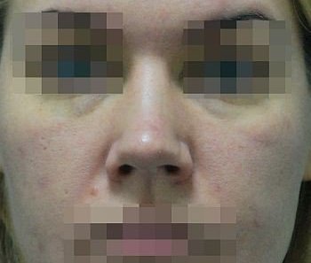 Выравнивание и сужение спинки носа - До
