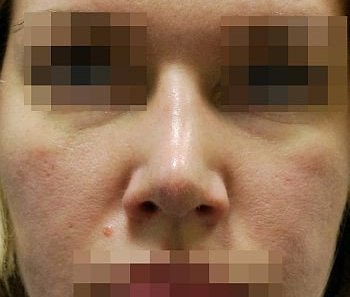 Выравнивание и сужение спинки носа - После