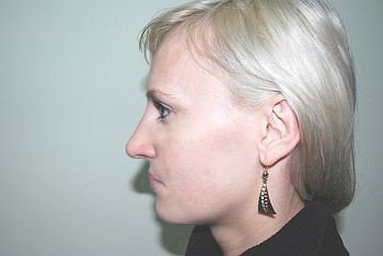 Исправление длинного, искривленного носа - После