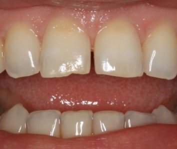 Коррекция положения и аномалии формы зубов - До