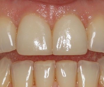 Коррекция положения и аномалии формы зубов - После