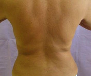 Липоскульптура спины в сочетание с программой по коррекции веса - После